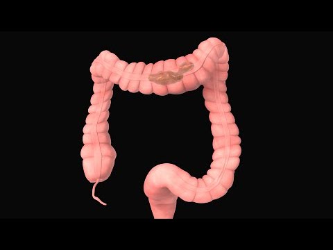 Diferencia entre intestino perezoso y estreñimiento