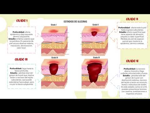 Úlceras por presión: estadios y tratamiento