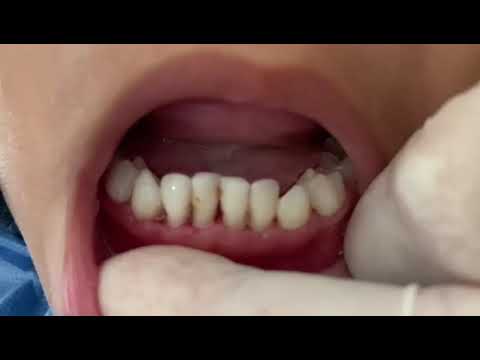 Estadios y grados de la periodontitis